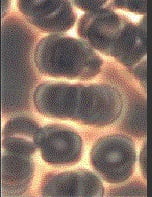 Clumped red blood cells before mild hyperbaric therapy