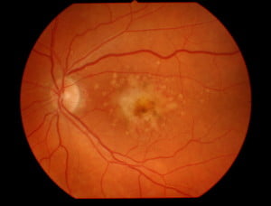 HBOT Macular Degeneration hyperbaric studies