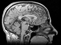 Parkinsons brain hyperbaric studies