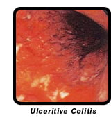 Ulceritive Colitis