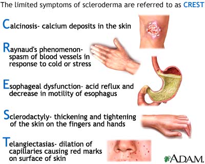 crest-syndrome