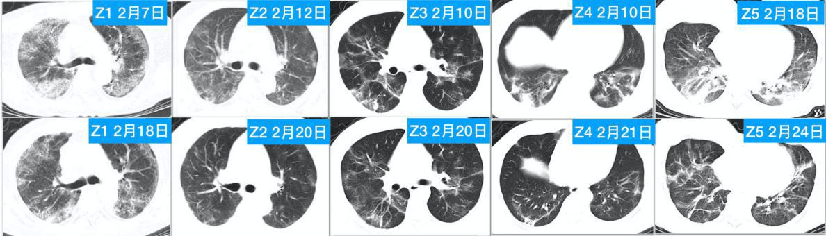 (pic 4) CT changes before and after 4-7 HBOT in 5 patients